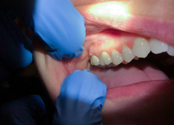 Best Emergency Tooth Extraction in Mattoon, IL