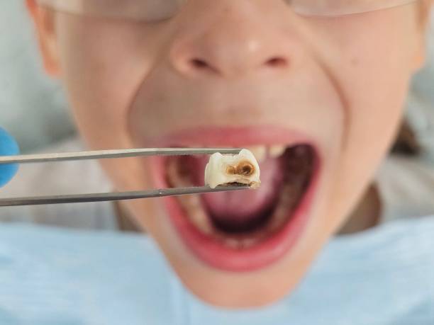 Best Emergency Tooth Extraction in Mattoon, IL