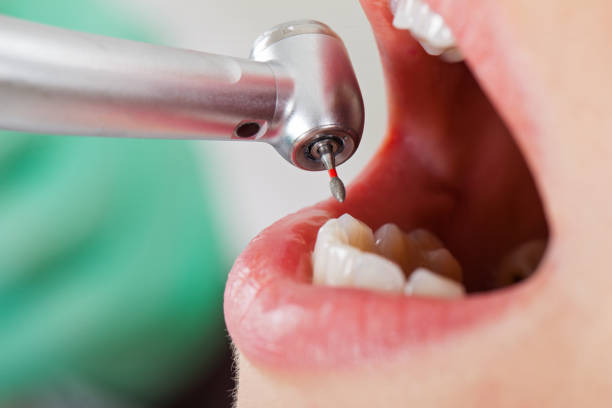 Best Emergency Tooth Extraction in Mattoon, IL